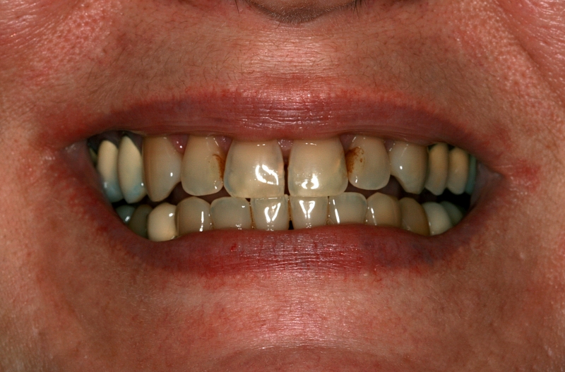 Are Veneers an Option for Discolored Teeth?